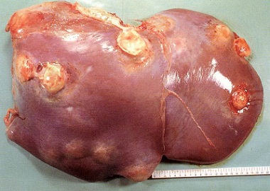肝膿瘍