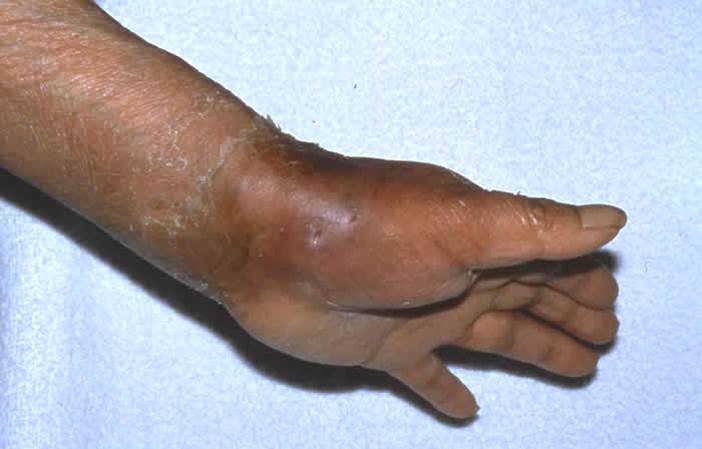 ネコの咬傷によるパスツレラ症の1例（フレグモーネ）の画像